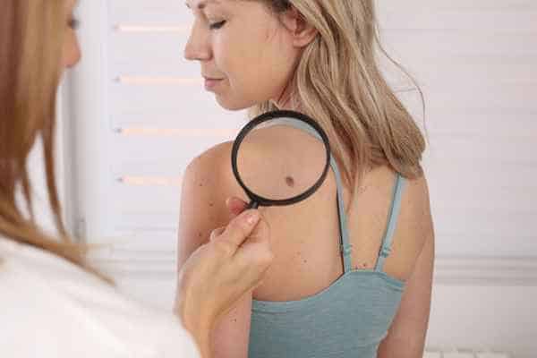 What Are Traditional Skin Lesion Removal Methods Hampton Court?