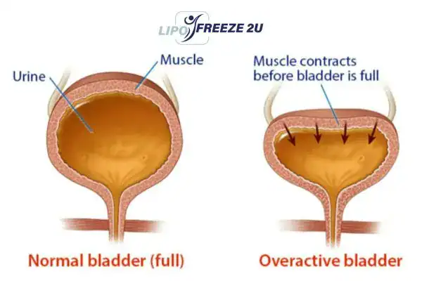 diagram of overactive bladder treatment Hampton Court