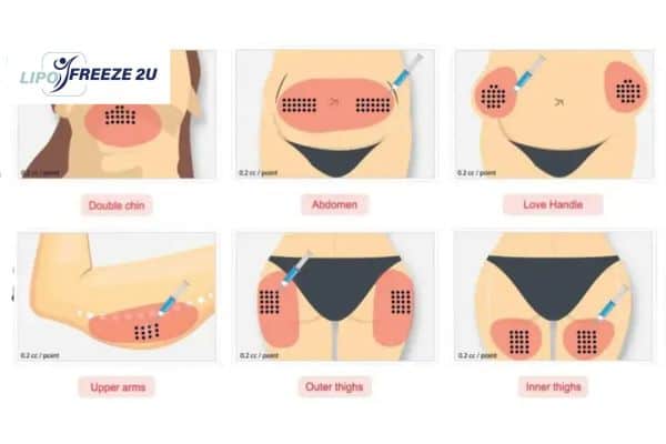 Benefits of Choosing Aqualyx for Fat Reduction Hampton Court