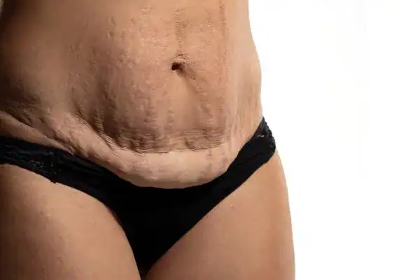 loose skin after weight loss injections Hampton Court