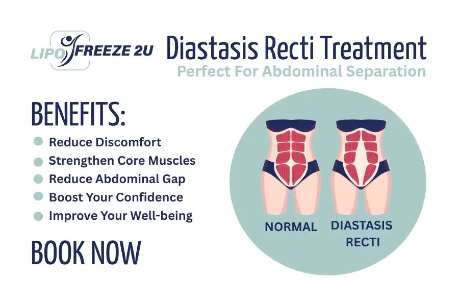 How Long Will It Take to See Improvements in Diastasis Recti Hampton Court