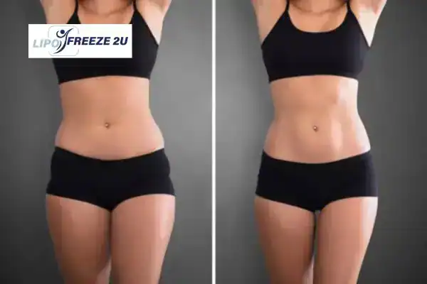 How Can LIPO FREEZE 2U Support Your Post-Pregnancy Body Recovery Hampton Court?