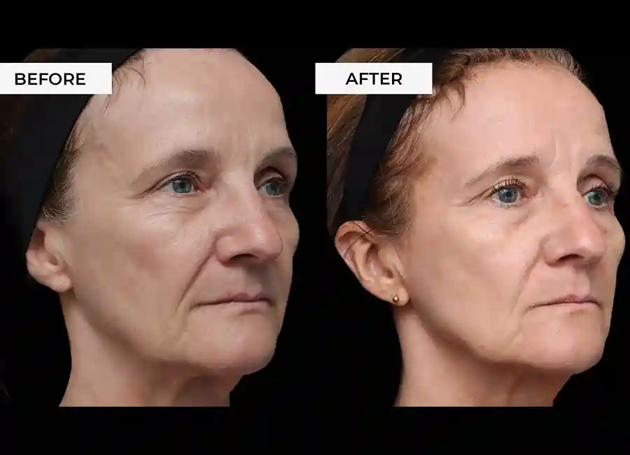 How Many RF Microneedling Sessions Will You Need to See a Difference Hampton Court?